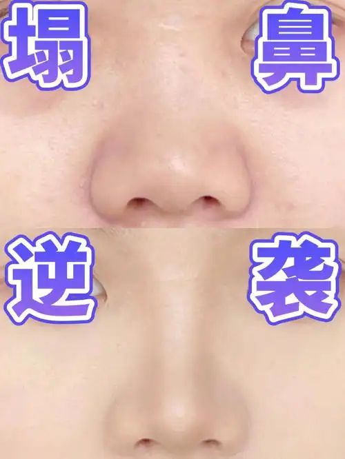 我又行了这手法哪个塌鼻蒜头鼻看了不迷糊