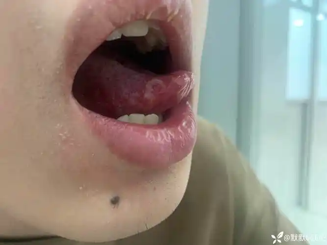 19岁男性出现上呼吸道感染症状和舌苔是否为口腔白色念珠菌感染