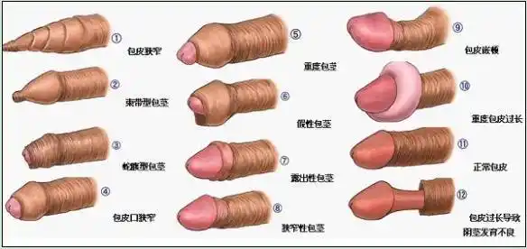 包茎麻醉方式是什么