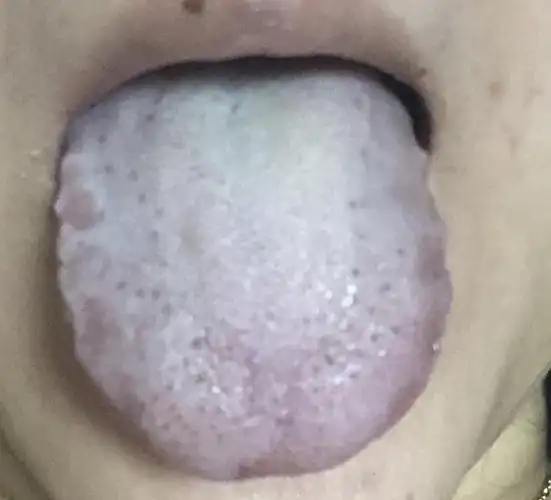 舌头很厚舌苔白有减轻大家帮我看看是不是有好转
