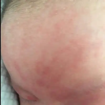 宝宝有时哭完额头上就会成这样,应该是皮肤下面的