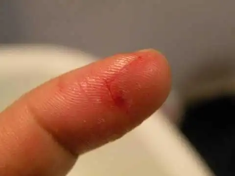 儿童手指割破:家长应该怎么去处理?什么样的情况需要去医院?