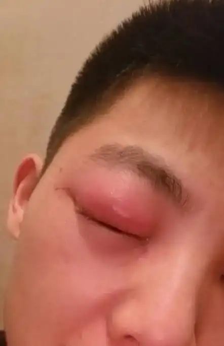 隆鼻后眼睛肿得很厉害怎么办_做完隆鼻眼睛肿的厉害是正常的吗?