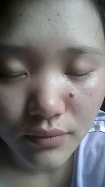 从小就有 能不能去掉 而且不留疤 2014-06-25 李庆峰 医师 脸上的黑痣