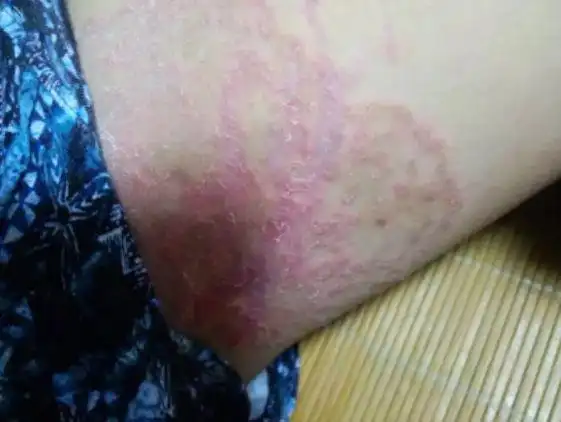 女性股藓症状表现的图片_有来医生