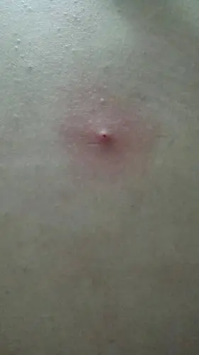 背部起痘痘是怎么回事?还这么大个!