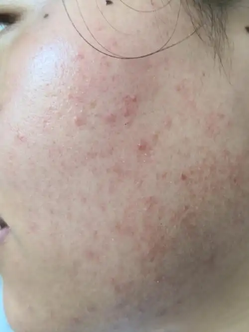 双侧面颊红斑丘疹症状.考虑痤疮.