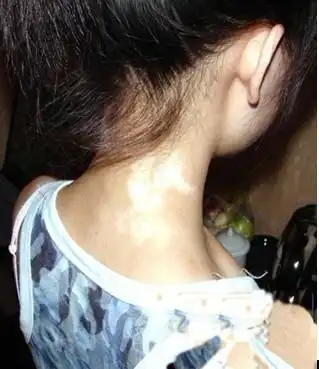 颈部白癜风的症状是颈部皮肤发白,有毛发产生,有部分病人白斑部位没有