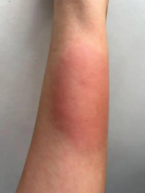 突然感到手臂一阵刺痛,往下一看,是被一只蚂蚁蛰咬,留下一处红点