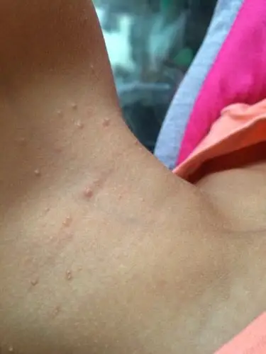 问:请问一下这是扁平疣吗?宝宝说不痒也不痛,不过摸起来感觉有点粗糙!