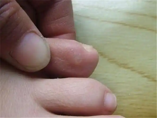 手心手指上长鸡眼初期图片