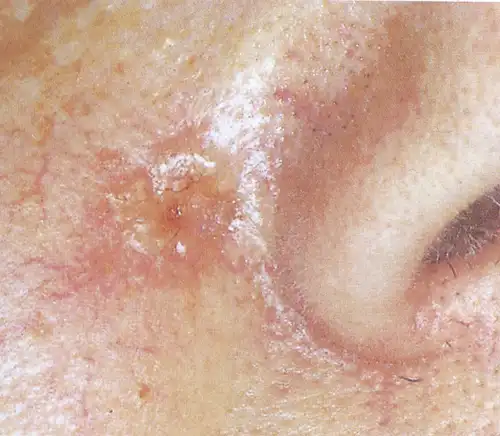 基底细胞癌的病理分析与临床表现