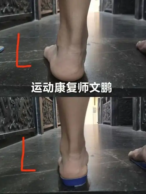 跟骨外翻怎么办