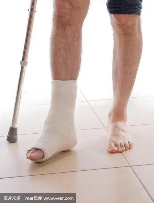 一个脚踝骨折,腿上打了石膏的年轻人