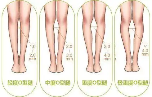 大腿与脚踝靠近以后,可以看到腿中间位置明显外翻,膝盖不能并拢或者