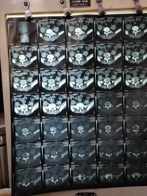 术前ct显示腰5骶1椎间盘突出伴钙化