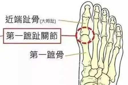 痛风为何偏爱足部第一跖趾关节?本文为你解惑!