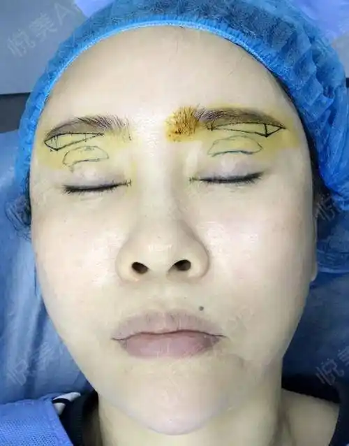 切眉提眉手术当天_眼综合整形手术当天_眼周年轻化手术当天_眼型矫正