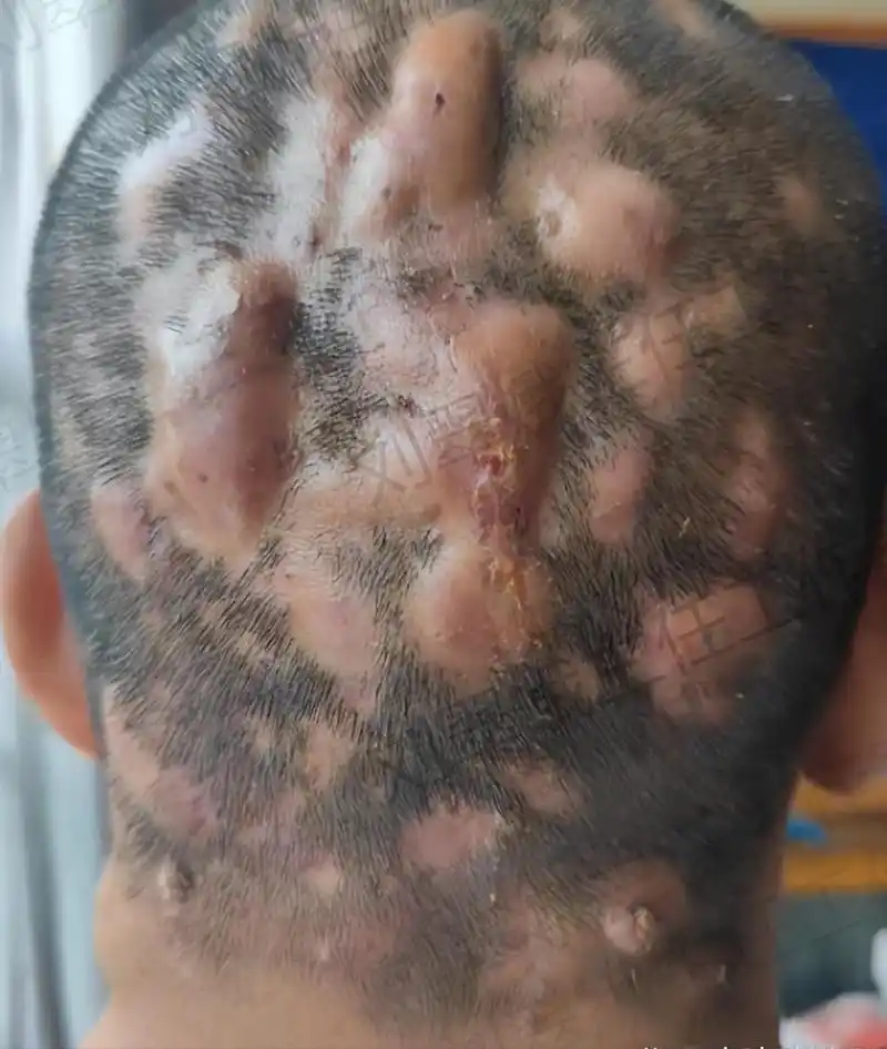 小伙子刚来看诊的时候说:"刘主任您看看我头上的包,都十年了,还有