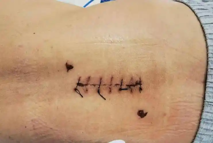 随着脊柱微创技术的发展,现可在脊柱微创通道技术下进行腰椎间盘突出