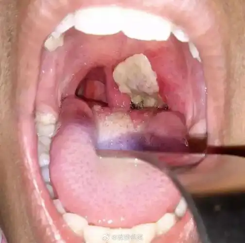 体格检查发现咽部充血,扁桃体,悬雍垂和咽后壁上有灰白色薄膜粘附.