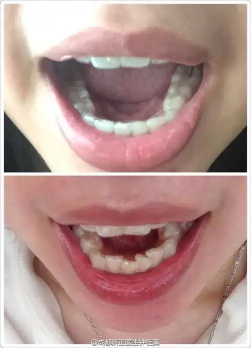 6到13岁换牙阶段,磨牙属于正常现象,但是过了换牙期,还常有磨牙现象