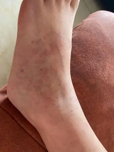 [试管婴儿]36 2脚面出现血管很红成片