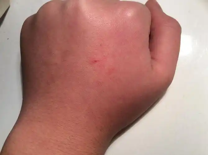 跟狗玩的时候被狗爪子挠破了,伤口很浅,是自己家里养的狗,还用去打针