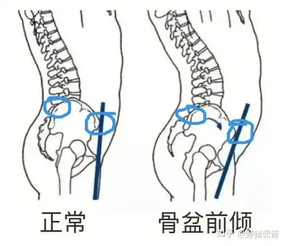04你真的骨盆前倾吗71骨盆前倾判断与改善