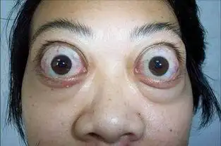 眼睛往外凸怎么办?