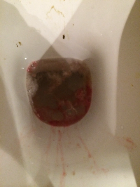 十六周吐出血了