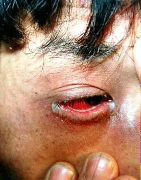 淋病的传播途径有哪些?