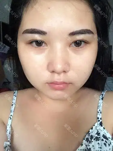 这是第二天,忽然发现我的眉毛一高一低有没有?而且_圈子-新氧美容整形