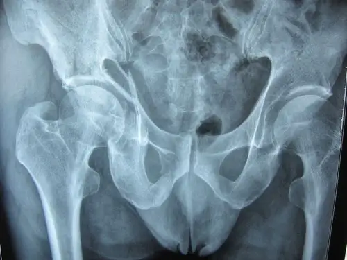 髋臼骨折,是否要手术治疗?