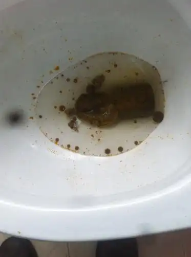 前几天开始右边胸口痛,现在还痛,今天早上拉大便发现拉出很多黄褐色的