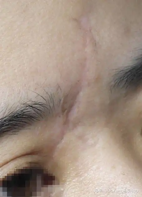 一例额部至上睑凹陷疤痕修复术后一年恢复情况