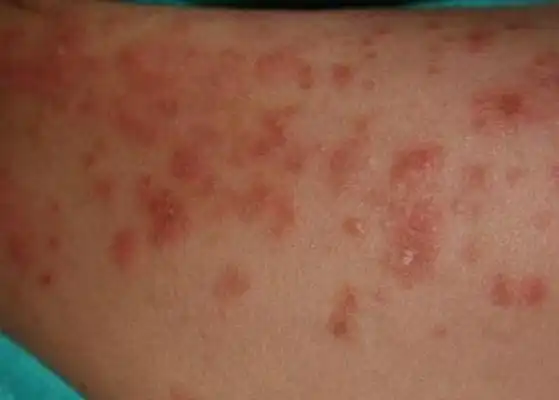 疥疮结节图片 (9)