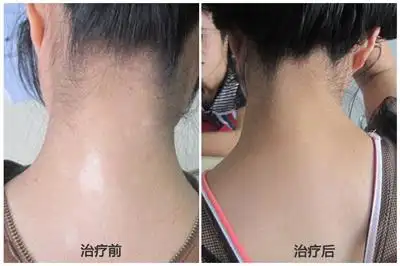 首页 疾病中心 白癜风治疗 正文   患者的身体和正常人有着本质的区别