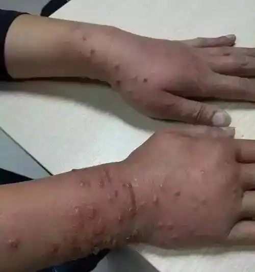 "小黑虫"出没,有人已经中招!