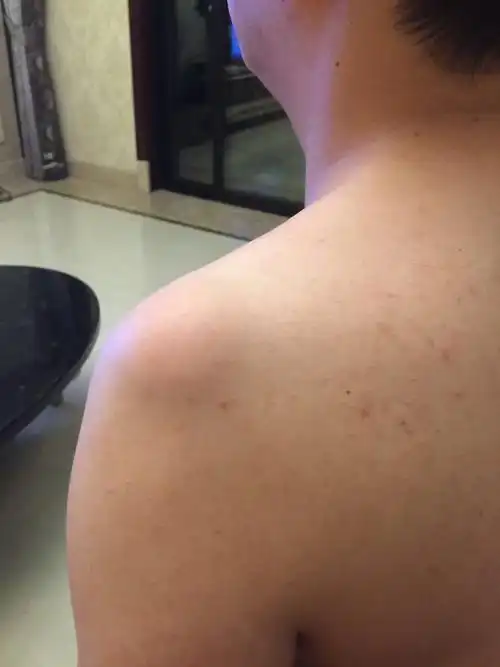 肩膀上鼓出一个包,不痛不痒,见照片,请专业人士看看是什么?谢谢帮忙