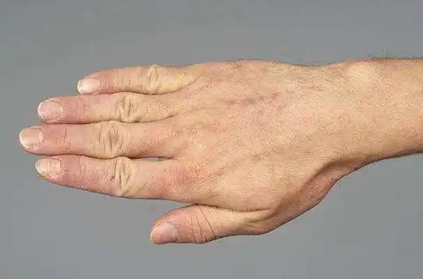 血糖高不高,看手就知道,若没这几种表现,恭喜,血糖还很稳定