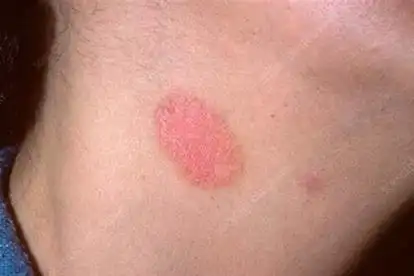 糖尿病皮疹图片和症状