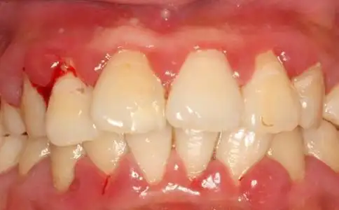 牙龈炎的治疗和护理方法