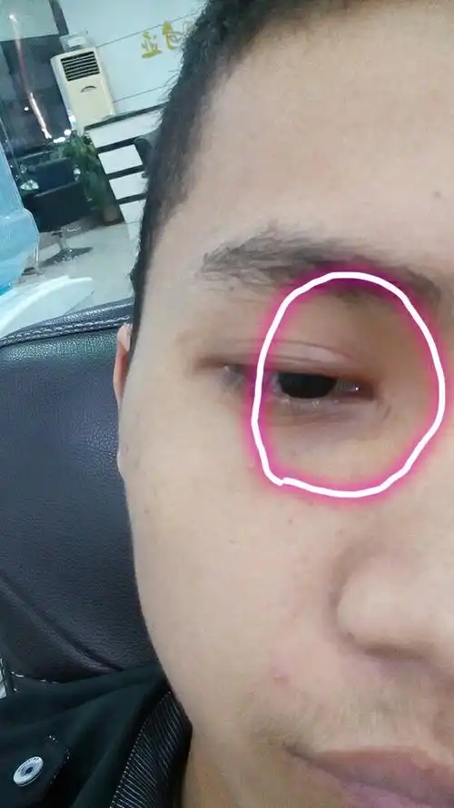 我的眼泪肿了怎么办