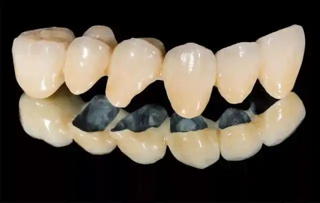 贵金属烤瓷牙又称为贵金属烤瓷牙,具有钛合金优点,非常牢固