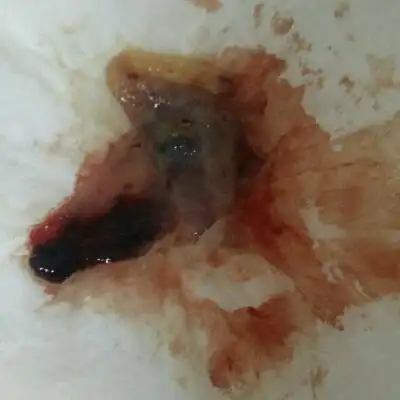 42天自然流产了,流了个这样的东西出来,这是我第一次流产,7天以后hcg