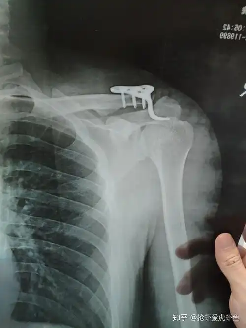 还必须是全麻,全麻醒来,下嘴唇麻了5天还麻一点点医生说两根韧带断了