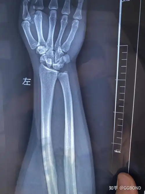 舟骨三角骨骨折及月骨周围脱位 - 知乎