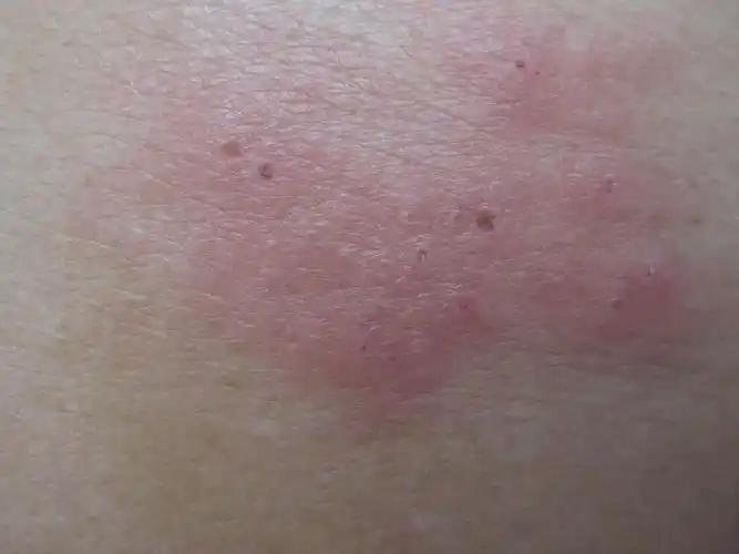 "后背出现红色疙瘩,疼"请哪位看看