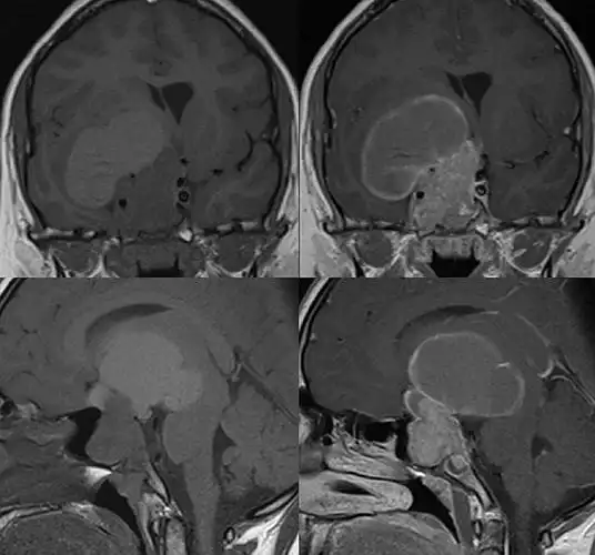 垂体泌乳素瘤 1 例